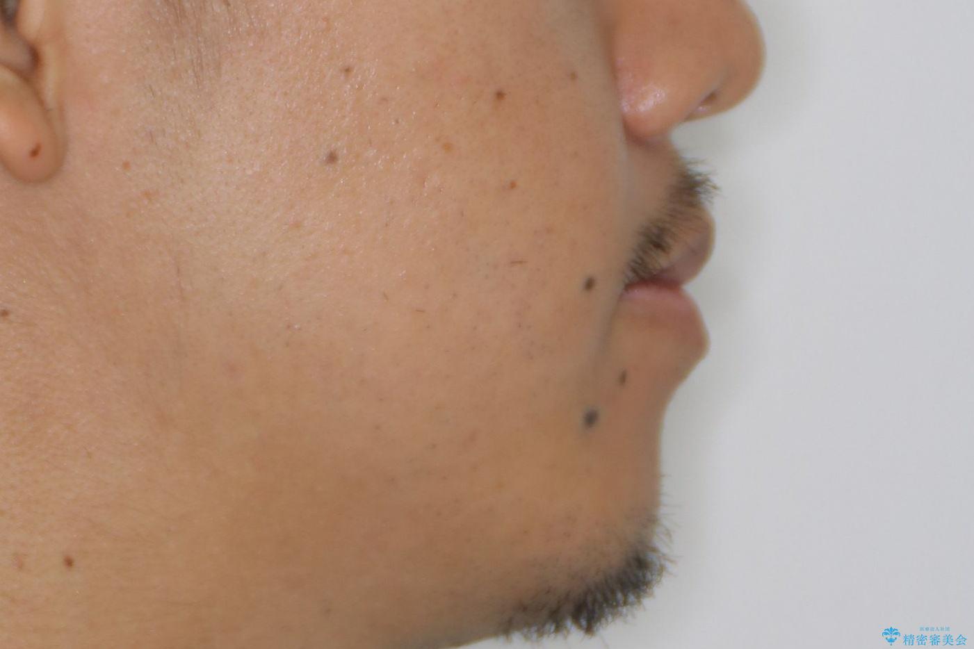 【MSE+インビザライン】前歯のガタガタの治療前(顔貌)