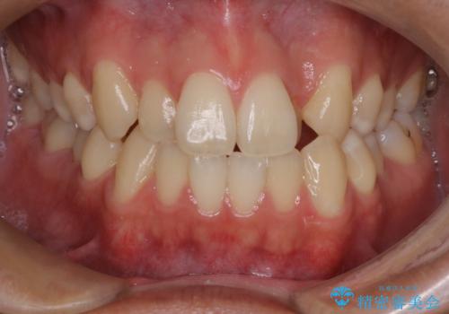 【MSE+インビザライン】前歯のガタガタの治療前