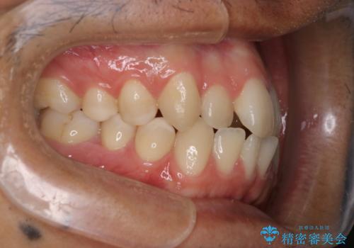 【MSE+インビザライン】前歯のガタガタの治療前