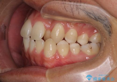 【MSE+インビザライン】前歯のガタガタの治療前