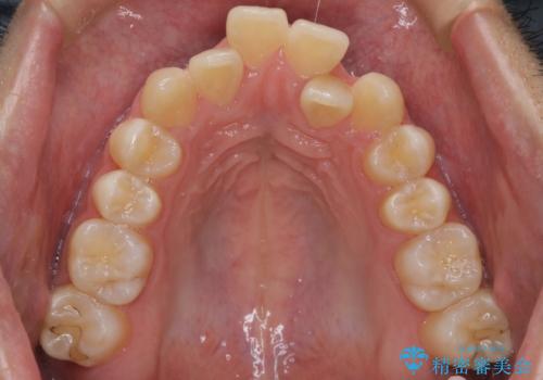 【MSE+インビザライン】前歯のガタガタの治療前