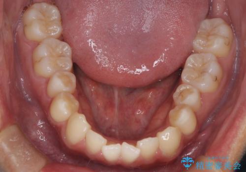 【MSE+インビザライン】前歯のガタガタの治療前