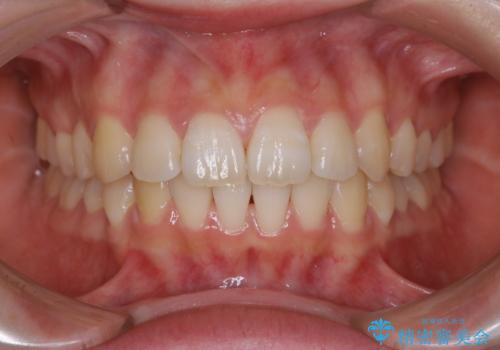 前歯の重なりは奥歯のズレが原因:まとめてインビザラインで治すの症例 治療後
