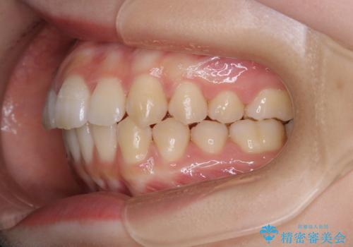 前歯の重なりは奥歯のズレが原因:まとめてインビザラインで治すの治療後