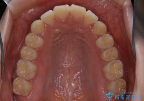 前歯の重なりは奥歯のズレが原因:まとめてインビザラインで治すの治療後