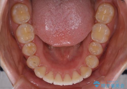 前歯の重なりは奥歯のズレが原因:まとめてインビザラインで治すの治療後