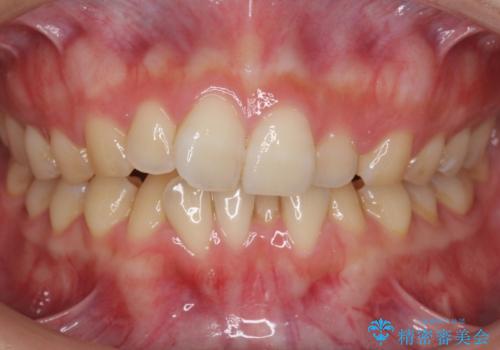 前歯のガタつき　インビザラインで　下の前歯を1本抜歯の症例 治療前