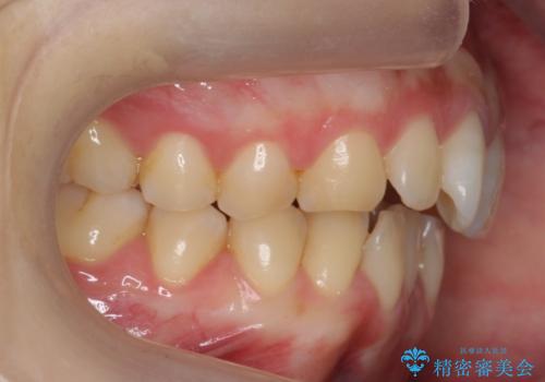 前歯のガタつき　インビザラインで　下の前歯を1本抜歯の治療前