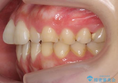 前歯のガタつき インビザラインで 下の前歯を1本抜歯の治療前