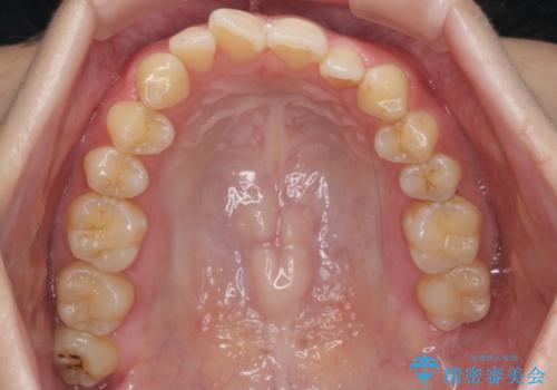 前歯のガタつき　インビザラインで　下の前歯を1本抜歯の治療前