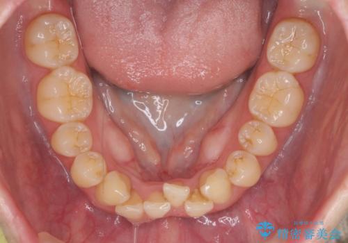 前歯のガタつき インビザラインで 下の前歯を1本抜歯の治療前