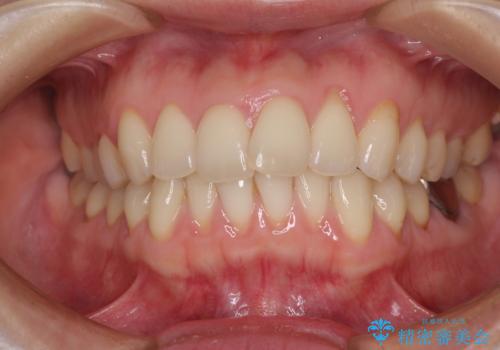 出産をしながら歯列を整える インビザラインによる矯正治療の治療前
