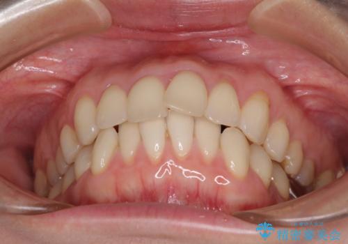 出産をしながら歯列を整える インビザラインによる矯正治療の治療前