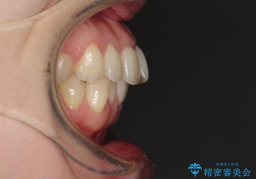 出産をしながら歯列を整える インビザラインによる矯正治療の治療前