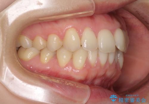 出産をしながら歯列を整える インビザラインによる矯正治療の治療前