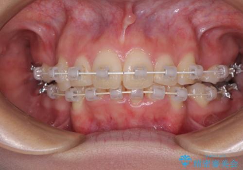 デコボコで飛び出した前歯 ワイヤー装置による抜歯矯正の治療中