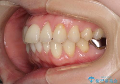 出産をしながら歯列を整える インビザラインによる矯正治療の治療前