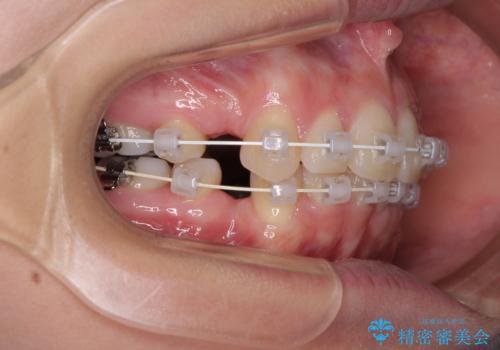 デコボコで飛び出した前歯 ワイヤー装置による抜歯矯正の治療中