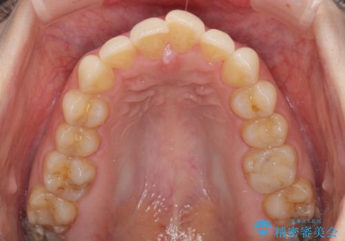 出産をしながら歯列を整える インビザラインによる矯正治療の治療前