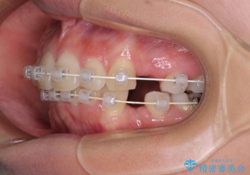 デコボコで飛び出した前歯 ワイヤー装置による抜歯矯正の治療中
