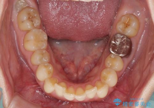 出産をしながら歯列を整える インビザラインによる矯正治療の治療前