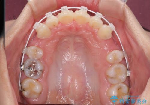 デコボコで飛び出した前歯 ワイヤー装置による抜歯矯正の治療中