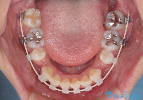 デコボコで飛び出した前歯 ワイヤー装置による抜歯矯正の治療中