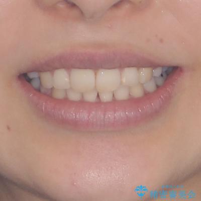 デコボコで飛び出した前歯 ワイヤー装置による抜歯矯正の治療後(顔貌)