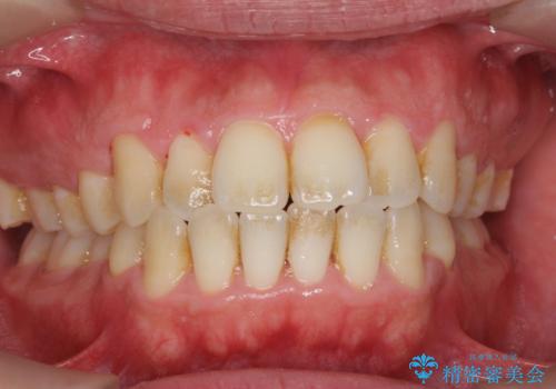 コーヒーによるステインをPMTC(医院で行うプロフェッショナルクリーニング)で除去の治療前