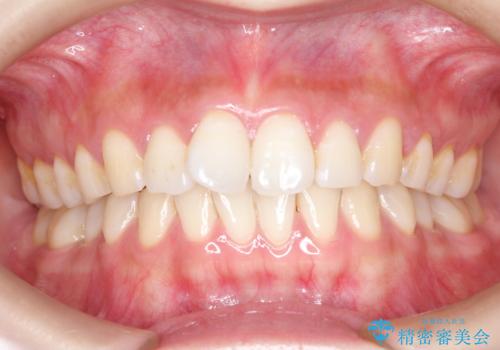 その前歯の捻じれ、原因は奥歯の噛み合わせのズレにあります。の症例 治療前