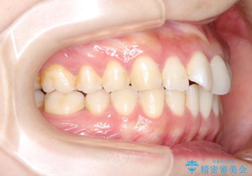 その前歯の捻じれ、原因は奥歯の噛み合わせのズレにあります。の治療前