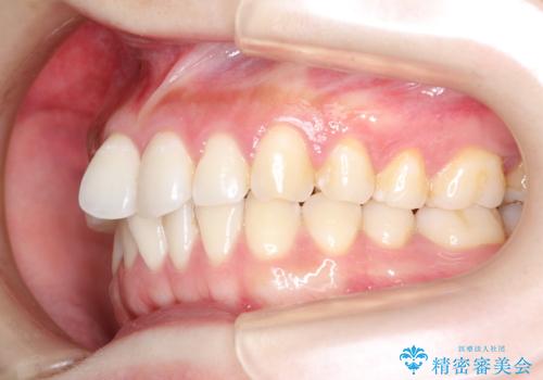 その前歯の捻じれ、原因は奥歯の噛み合わせのズレにあります。の治療前