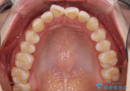 その前歯の捻じれ、原因は奥歯の噛み合わせのズレにあります。の治療前