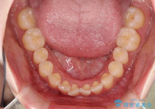 その前歯の捻じれ、原因は奥歯の噛み合わせのズレにあります。の治療前
