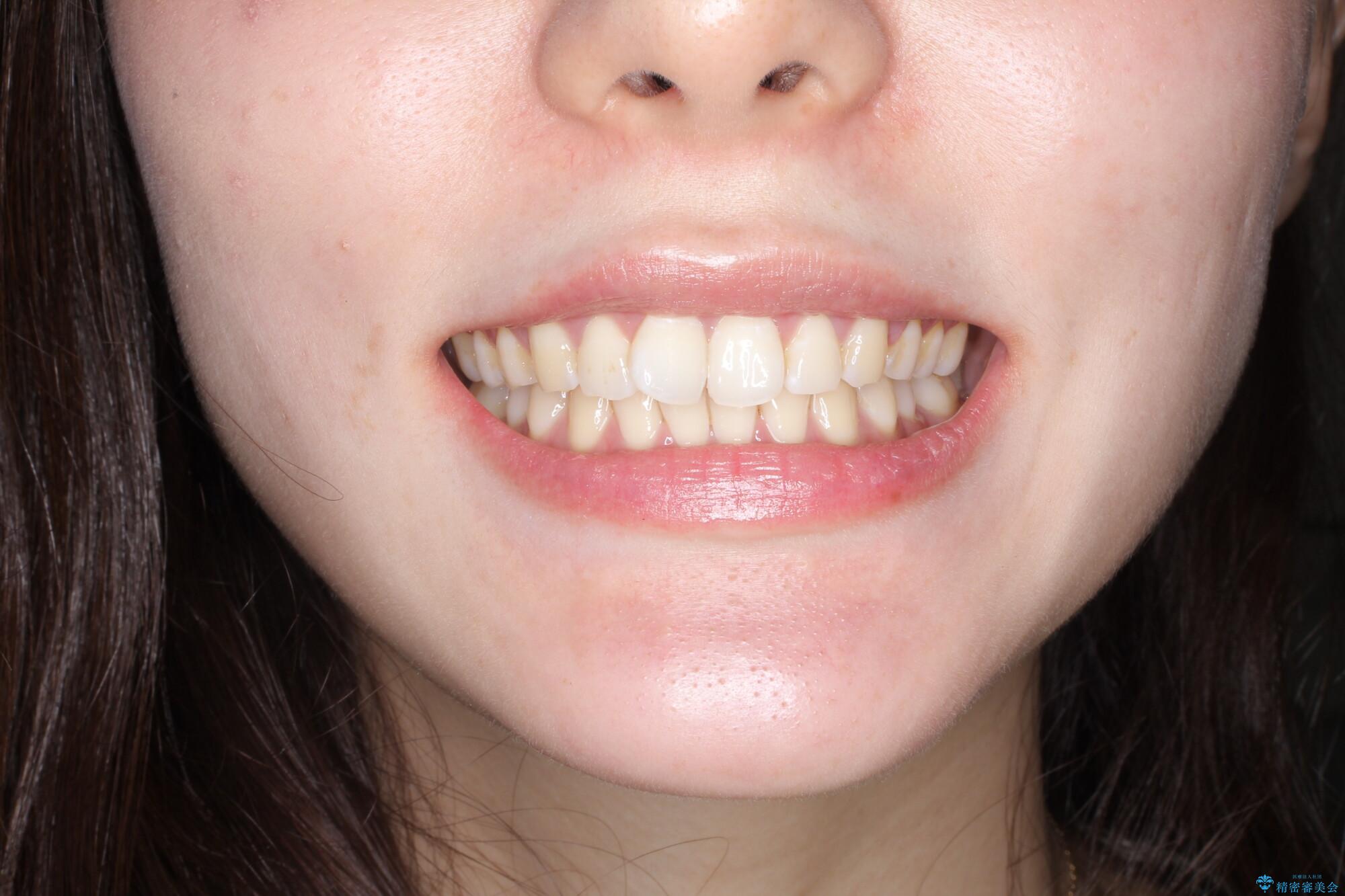 その前歯の捻じれ、原因は奥歯の噛み合わせのズレにあります。の治療前(顔貌)