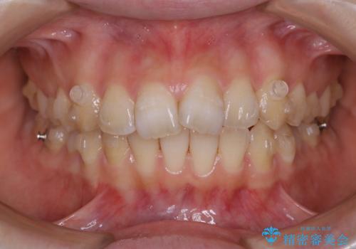 前歯の重なりは奥歯のズレが原因:まとめてインビザラインで治すの治療中