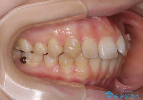 前歯の重なりは奥歯のズレが原因:まとめてインビザラインで治すの治療中