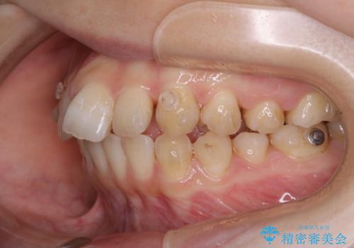 前歯の重なりは奥歯のズレが原因:まとめてインビザラインで治すの治療中