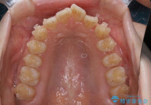 前歯の重なりは奥歯のズレが原因:まとめてインビザラインで治すの治療中