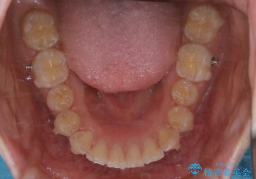 前歯の重なりは奥歯のズレが原因:まとめてインビザラインで治すの治療中