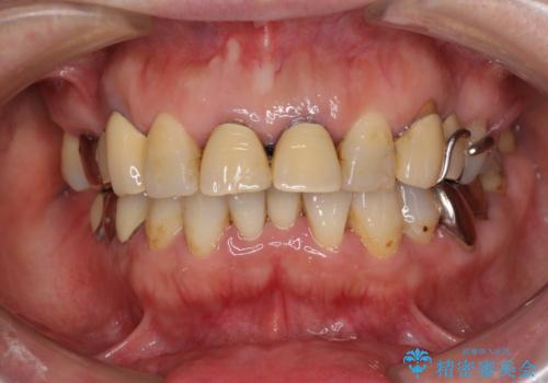 銀歯や入れ歯で汚い歯をきれいにしたい　総合歯科治療