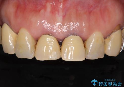 銀歯や入れ歯で汚い歯をきれいにしたい　総合歯科治療の症例 治療前