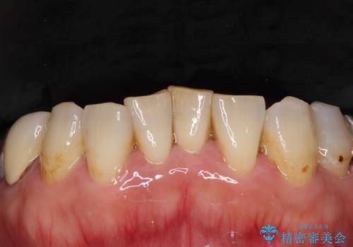 銀歯や入れ歯で汚い歯をきれいにしたい 総合歯科治療の治療前