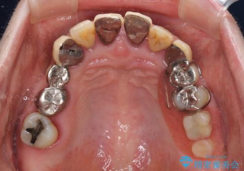 銀歯や入れ歯で汚い歯をきれいにしたい 総合歯科治療の治療前