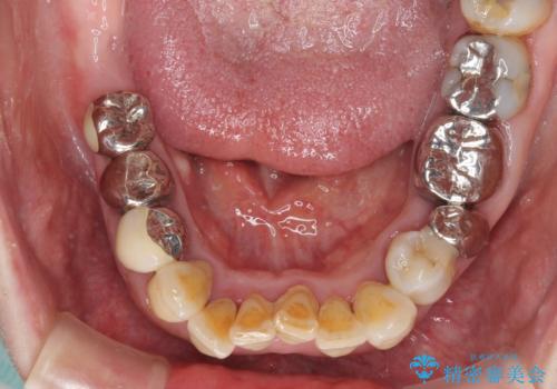 銀歯や入れ歯で汚い歯をきれいにしたい　総合歯科治療の治療前