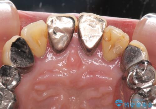 銀歯や入れ歯で汚い歯をきれいにしたい　総合歯科治療の治療前
