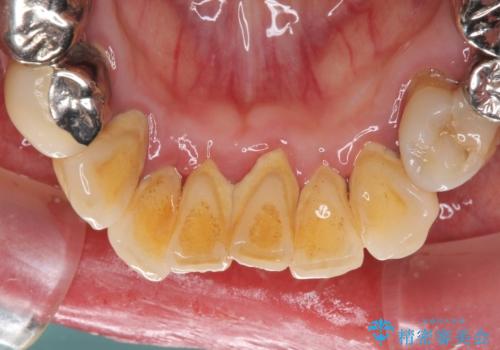 銀歯や入れ歯で汚い歯をきれいにしたい 総合歯科治療の治療前