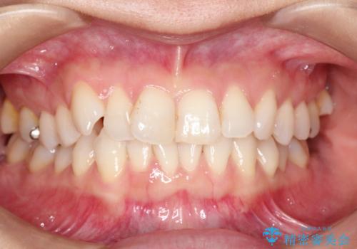 八重歯と前歯のガタガタをインビザラインでの症例 治療前