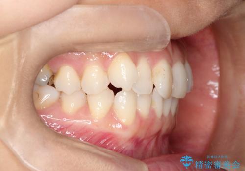 八重歯と前歯のガタガタをインビザラインでの治療前