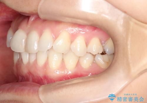 八重歯と前歯のガタガタをインビザラインでの治療前